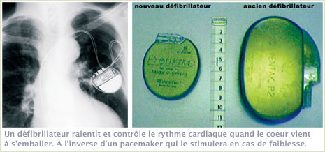 Défibrillateurs